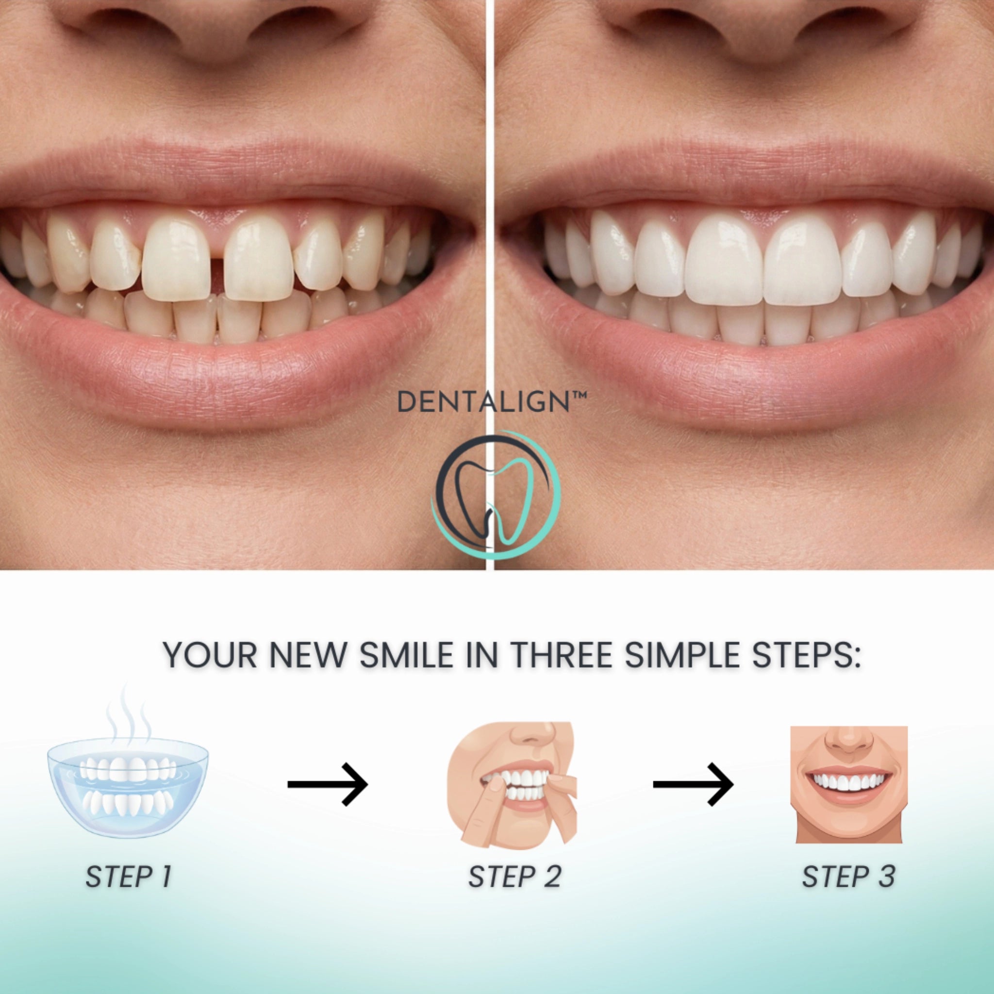 Clip-On Veneers - Dentalign™